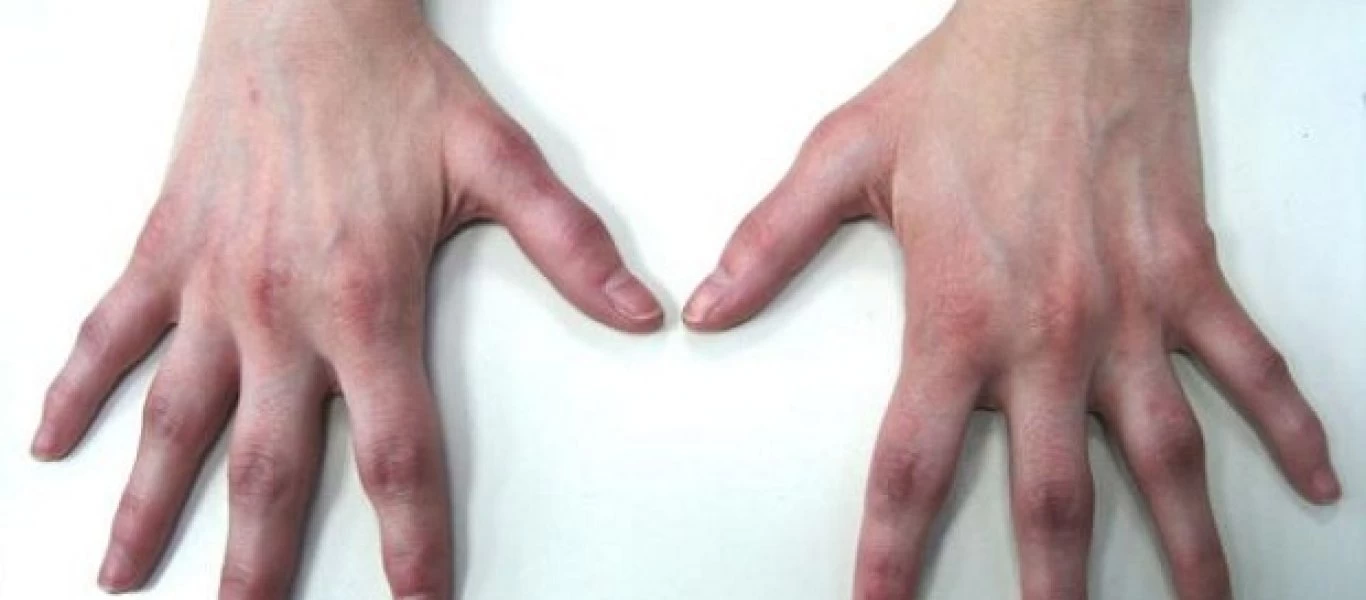 Αρθρίτιδα: Μπορεί να βοηθήσει η σύγχρονη χειρουργική;